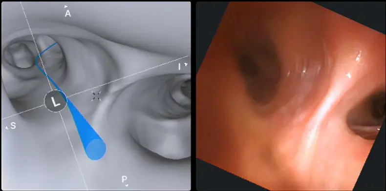 3D roadmap of the lungs with the proposed access routes to the nodule(s) shown by the blue line