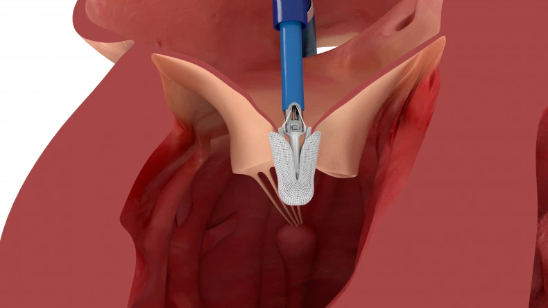 A new minimally invasive treatment for tricuspid regurgitation | Royal ...